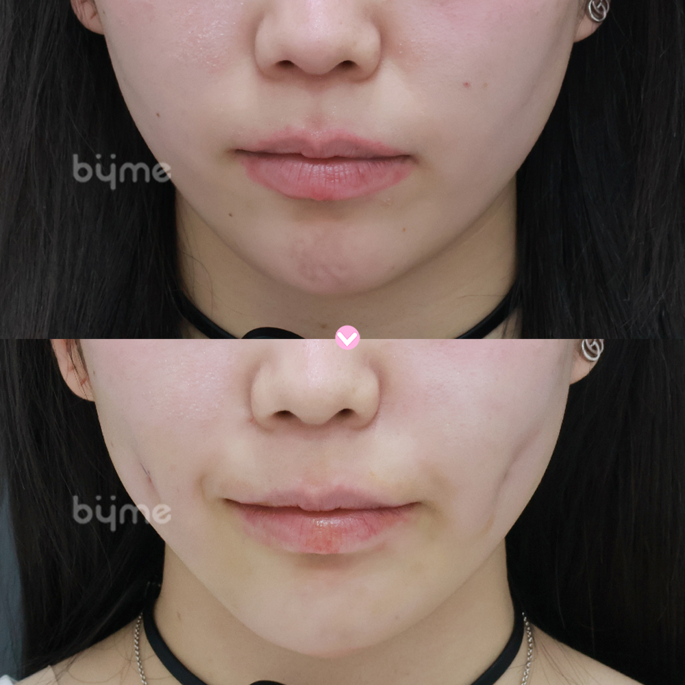 보조개_야마다 하루카_전후 (1).jpg
